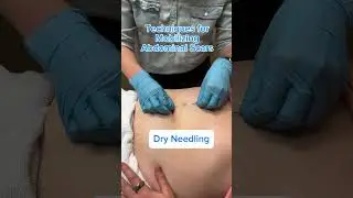 Ways to Mobilize Abdominal Scars
