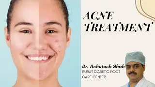 Permanment  solutation for pimple, ways to prevent  pimple ,best clinic in Vesu, Pal , Citylight