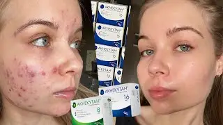 MY ACNE TREATMENT JOURNEY | Systemic Retinoids