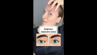 Лифтинг верхнего века 