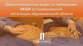 VASER-ассоциированная липосакция абдоминальной области
