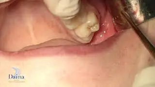 Centro Daina - Estrazione Dente del Giudizio in Inclusione Ossea Totale