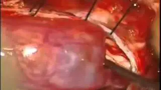 Операция - удаление шванномы спинного мозга