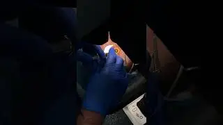 Liberate de tus lentes, cirugía para miopía y astigmatismo