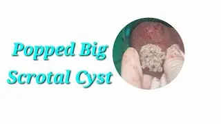 Popped Scrotal Cyst(अंडकोष पर गांठ) No. 89