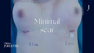 Minimal scar