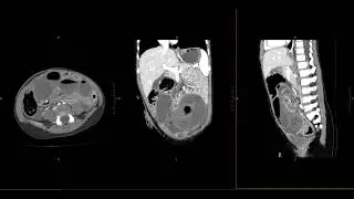 Abdominal Imaging Call Prep Cases: C​l​o​s​e​d​ ​L​o​o​p​ ​SBO (CT) Case 3 Discussion