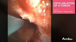 Cryoablation of a Tumor | Dr. Hinze Using the aScope 5 Broncho HD