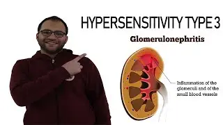 Hypersensitivity type 3