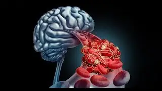 Stroke // Part - 2 //
