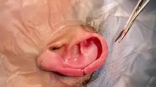 Dr. John E. Sherman - Ear Reduction (Macrotia)