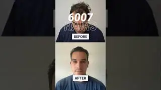2200 Grafts FUE Method  Hair Transplant Result #shorts #hairtransplantbeforeafter