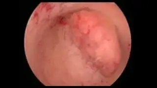 1 polyp by osama shawki