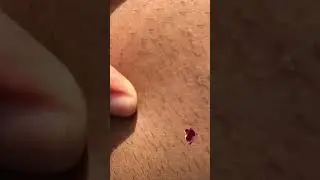 malaria 