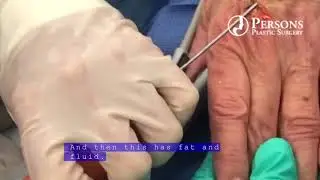 Hand Rejuvenation and Fat Grafting