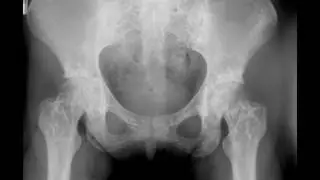 Osteopoikilosis