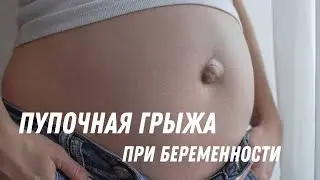 Пупочная грыжа при беременности 