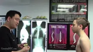 Scoliosis, chronic fatigue syndrome, heartburn, GERD, headache, sinus infections - Gonstead
