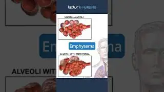 Exploring Emphysema 🔍 