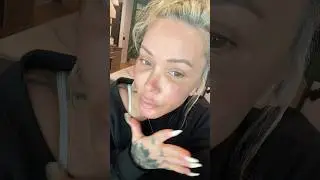 Day 12 of facelift- I messed up!