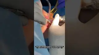 Амалиети мондани имплант