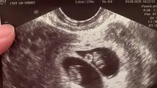 Surprise! TWIN Girls! 16 Weeks!