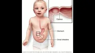 Causes of Pyloric Stenosis