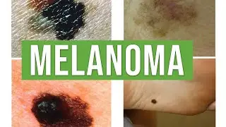 Melanoma vs Benign Melanocytic Nevus | Lecturio Dermatology