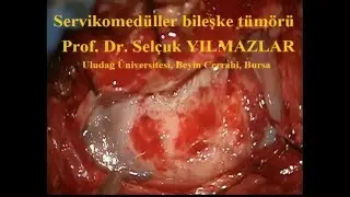 servikomedüller bileşke meningiomu