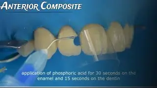 Class III Composite restoration Full case protocol from A to Z