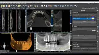Simple Trick for Distal Extension Guides