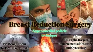 Breast reduction surgery / Technique de Réduction mammaire