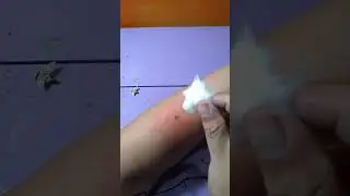 Укус пчелы  #полезныесоветы