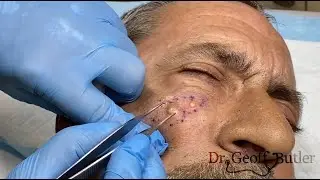 Removal of Multiloculated Cyst and Scar Tissue on the Face