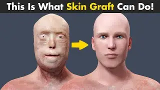 How Skin Transplant (Skin Graft) Is Performed? | Skin Graft Procedure