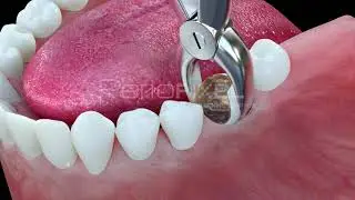Vídeo 3D Evitar troneras mediante tratamiento de ortodoncia - Tráiler