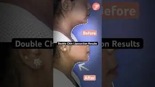 Double Chin Liposuction Before and After #youtube #chinliposuction #sbaesthetics #drshilpibhadani