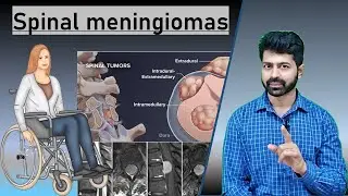 What is spine meningiomas and how to treat them ? Recovery after the operation. By Dr Skanda