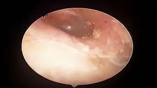 Fluid behind eardrum because of cold - how does it look like?
