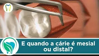 Aumentos de coroa clínica em faces proximais