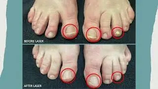 Authentic Results: Using Cutera Laser to Cure Fungal Toenails