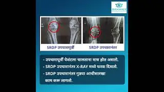 knee pain ll joint pain ll Srdp Treatment