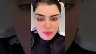 HÜLYA MİZGİN : “KEL OLMUŞUM,DEPRESYONA GİRDİM “
