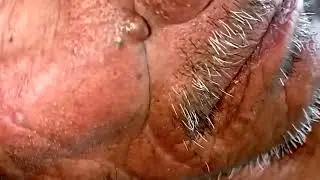 Black head removal on face - Blackheads on back treatment