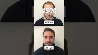 Paul's result 12 months after hair transplant #shorts #fuehairtransplant