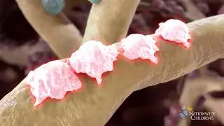 What is an Aneurysmal Bone Cyst? | Symptoms. Causes. Diagnosis. Treatment.