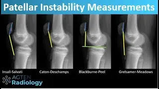 Patellar Instability - What and How to Measure