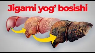Jigarni yog' bosishi xavflari, belgilari va davolash!
