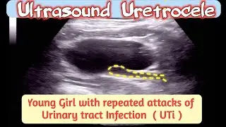 Ultrasound URETROCELE - Case of Young Girl with Repeated UTI,s ( Urinary Tract Infection )