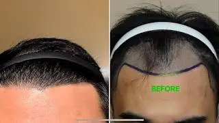 15 MONTHS Update - Motion Hair Clinic, Gangnam